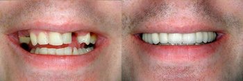 Smile Gallery - Gentle Dental Group, Yorkville Dentist