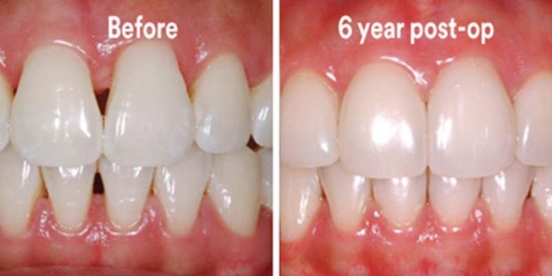 BioClear Diastema Closure and Black Triangle Closure  - Gentle Dental Group, Yorkville Dentist