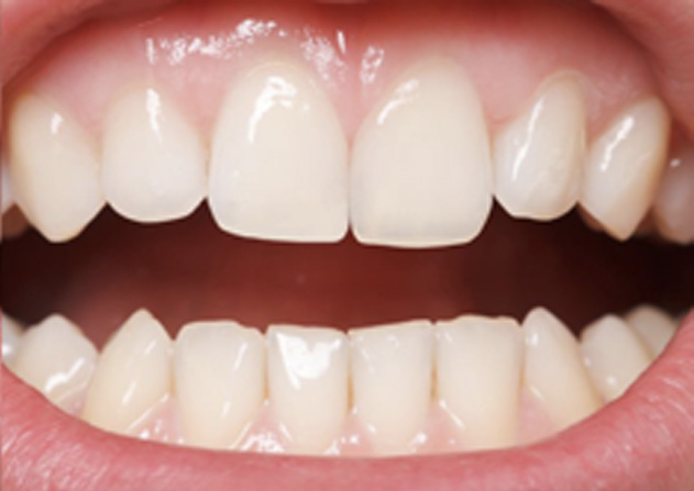 Cosmetic Bonding  - Gentle Dental Group, Yorkville Dentist
