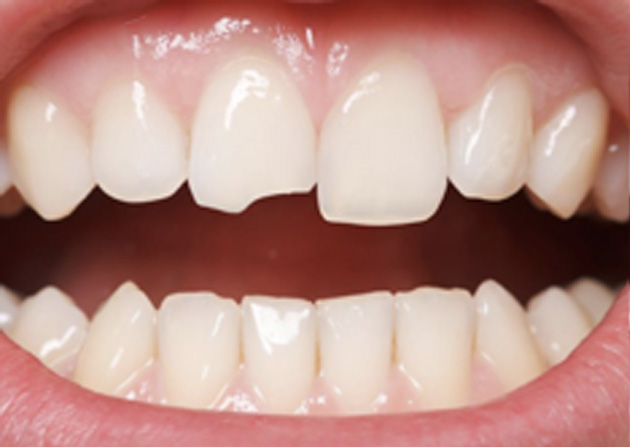 Cosmetic Bonding  - Gentle Dental Group, Yorkville Dentist