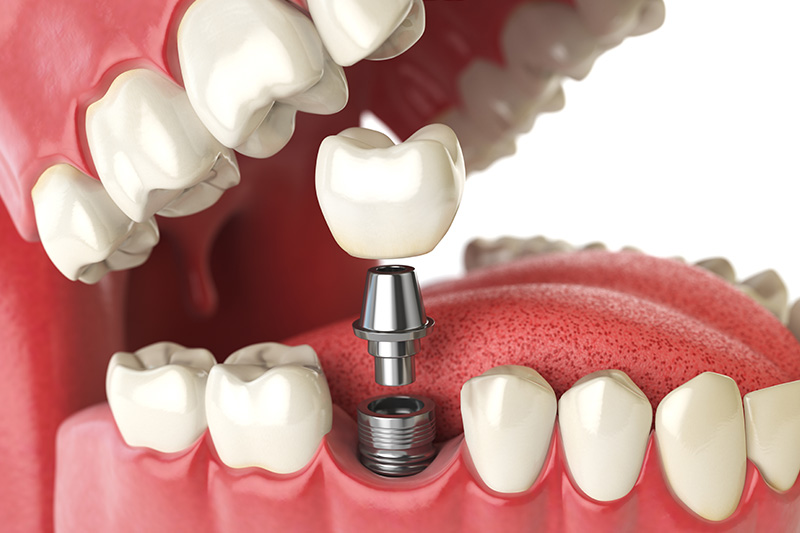 Dental Implants - Gentle Dental Group, Yorkville Dentist