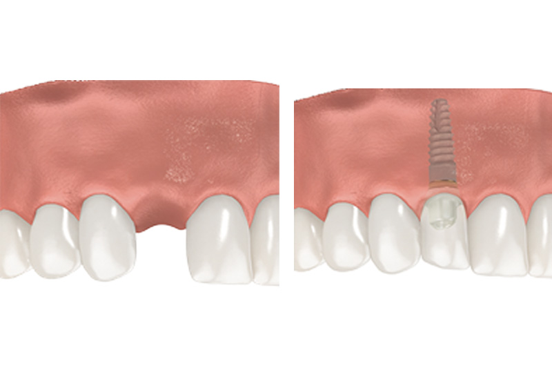 Dental Implants - Gentle Dental Group, Yorkville Dentist