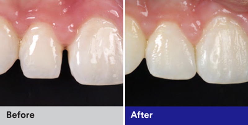 BioClear Diastema Closure and Black Triangle Closure  - Gentle Dental Group, Yorkville Dentist