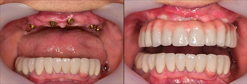 Implant Overdentures and Fixed All-On-X Treatment  - Gentle Dental Group, Yorkville Dentist