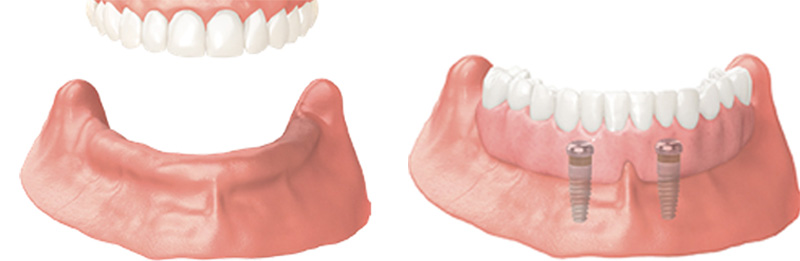 Implant Overdentures and Fixed All-On-X Treatment  - Gentle Dental Group, Yorkville Dentist