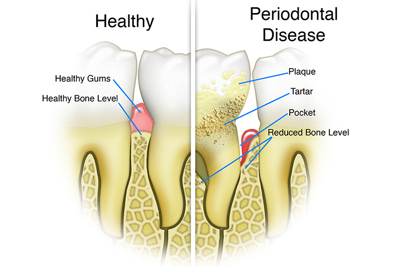 Scaling & Root Planings (Deep Cleanings)  - Gentle Dental Group, Yorkville Dentist