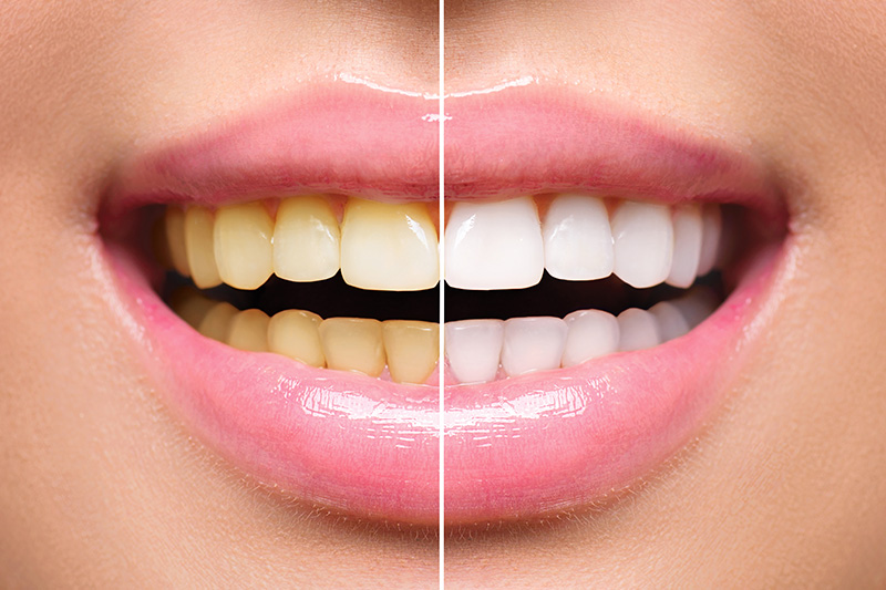 Teeth Whitening - Gentle Dental Group, Yorkville Dentist