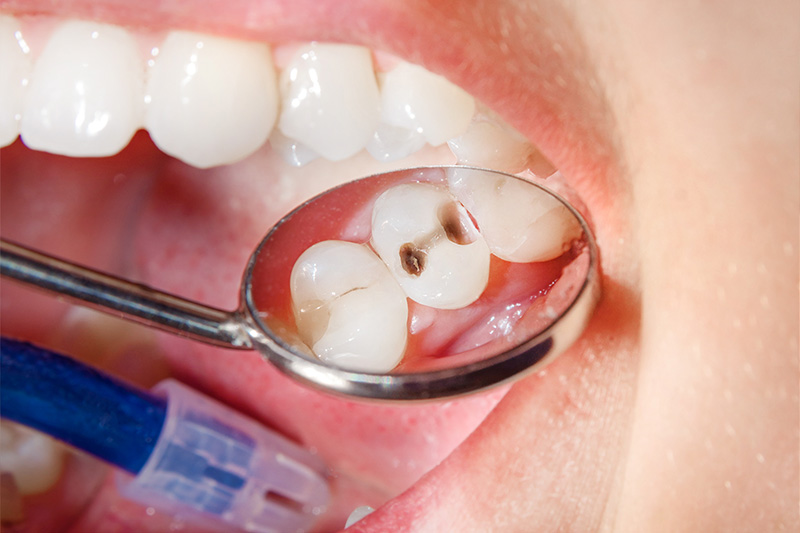 Tooth Colored Composite Fillings  - Gentle Dental Group, Yorkville Dentist