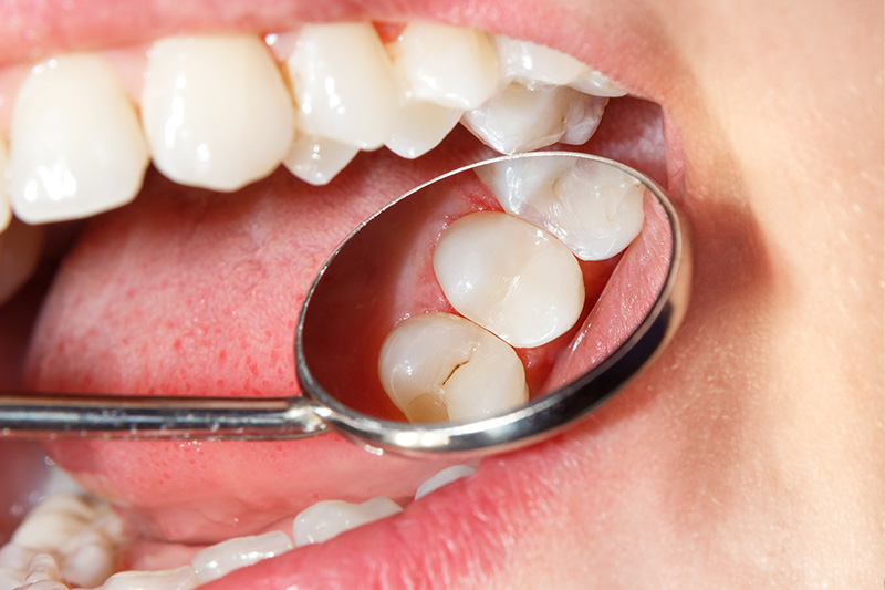 Tooth Colored Composite Fillings  - Gentle Dental Group, Yorkville Dentist