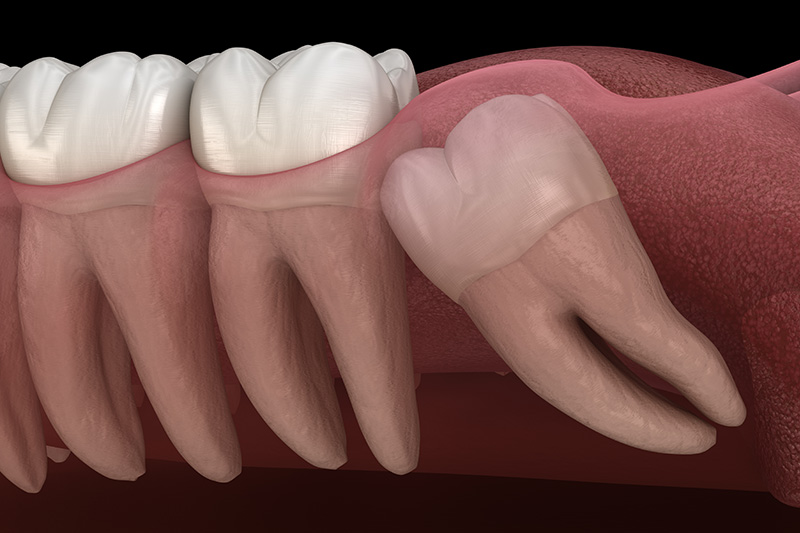 Wisdom Teeth Extractions (with Sedation)  - Gentle Dental Group, Yorkville Dentist